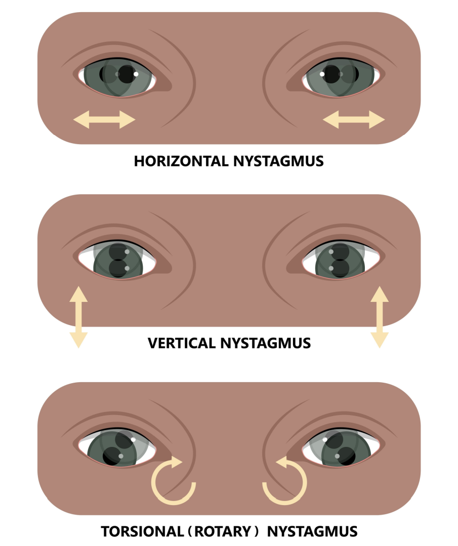 Nystagmus Graphic